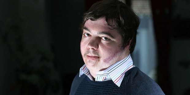 Harcelement-scolaire-8-ans-apres-avoir-tente-de-s-immoler-par-le-feu-Jonathan-Destin-temoigne